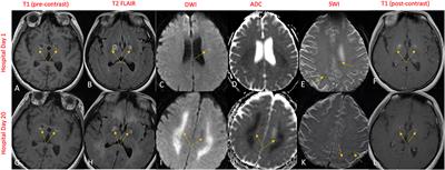 Case report: Bilateral globus pallidus lesions and delayed progressive leukoencephalopathy in COVID-19: Effects of hypoxia alone or combination of hypoxia and inflammation?